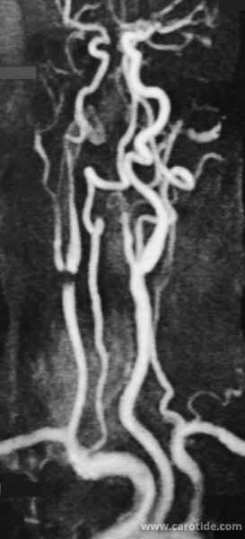 angio-irm