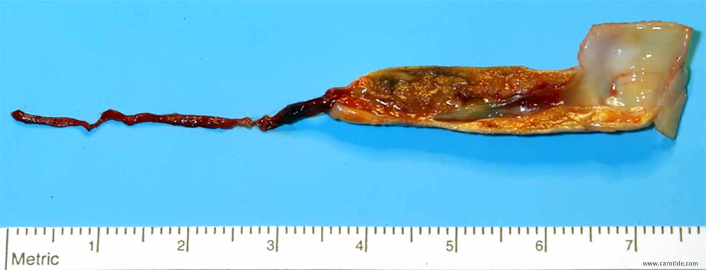 Plaque nécrosée quasi occlusive avec en aval un caillot flottant de 3,5 cms de long, de calibre irrégulier