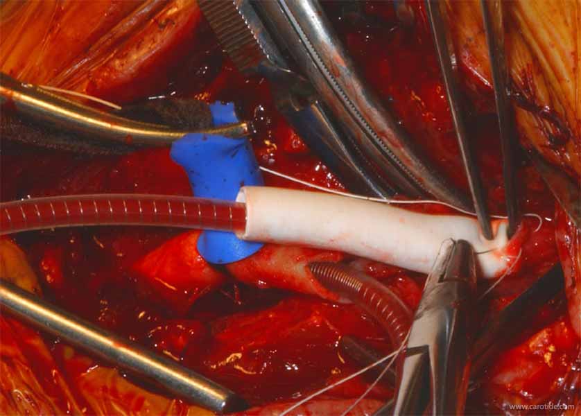 pontage carotidien sous shunt-suture distale