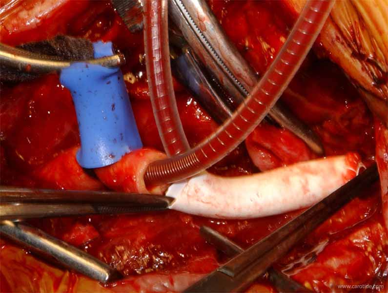 pontage carotidien sous shunt-vérification de la longueur
