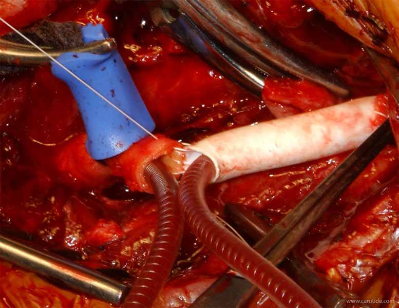 pontage carotidien sous shunt-suture de la prothèse à la carotide en arrière