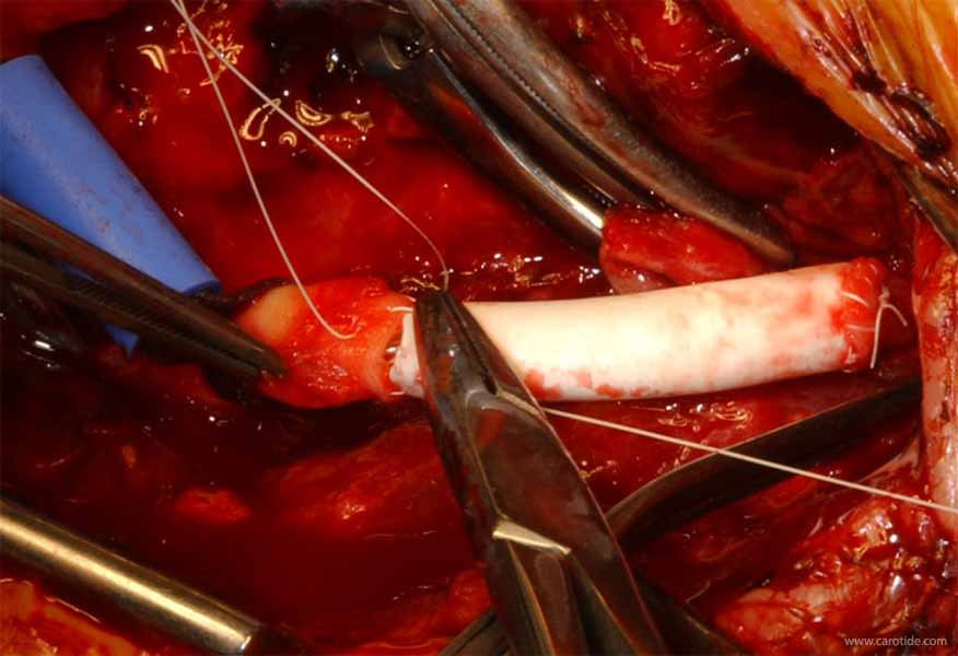 pontage carotidien sous shunt-suture de la prothèse à la carotide en avant