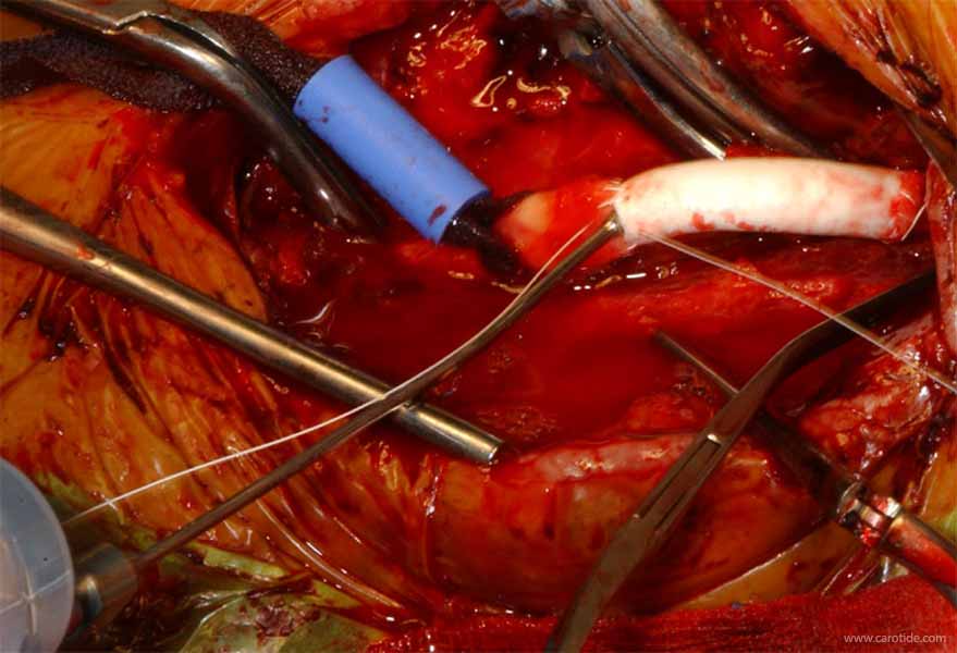 pontage carotidien sous shunt-purge et rinçage