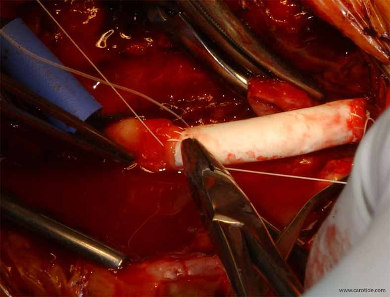 pontage carotidien sous shunt-finalisation de la suture