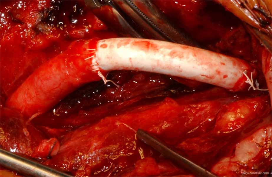 pontage carotidien sous shunt-après déciampage