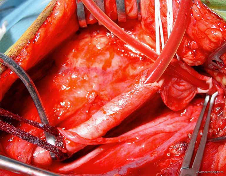 shunt carotide exces de longueur de l'axe carotidien