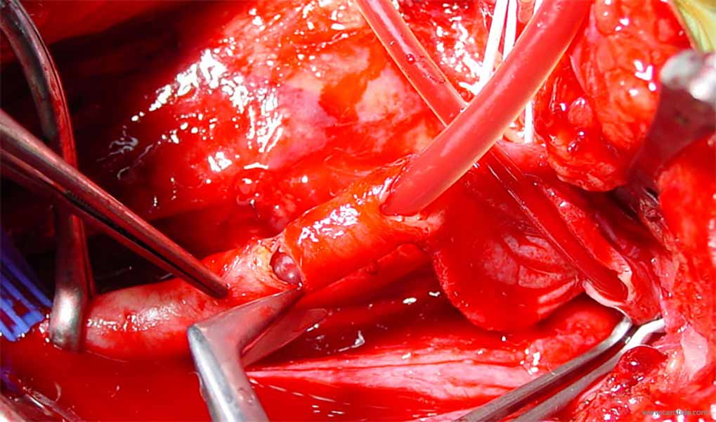 shunt carotide incision transversale de la carotide commune