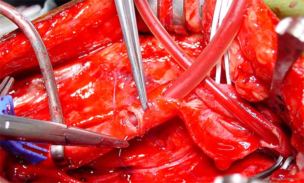 shunt carotidien, suture