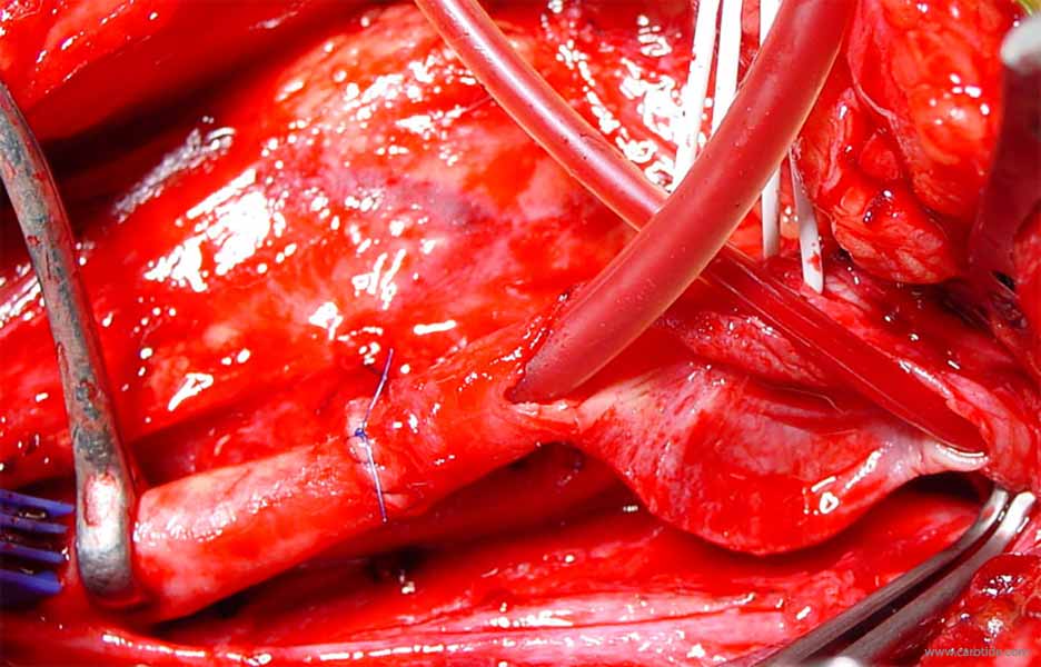 shunt carotidien, anastomose termino-terminale de la carotide commune.