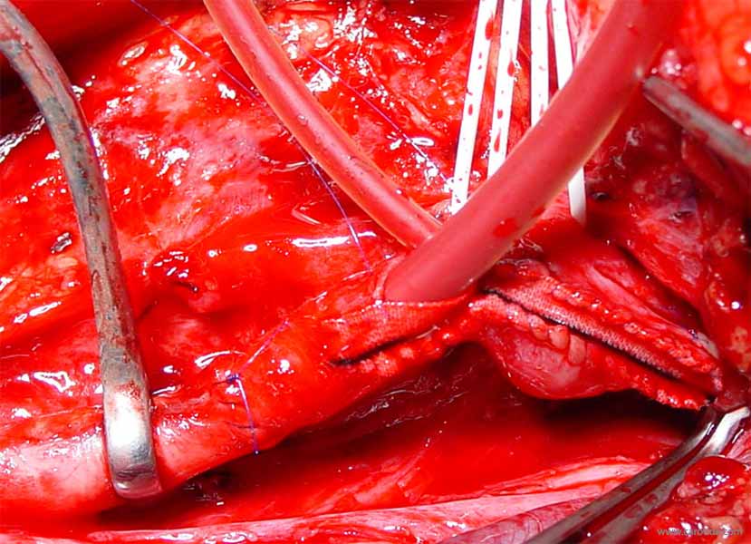 shunt carotidien, fermeture de l'artériotomie