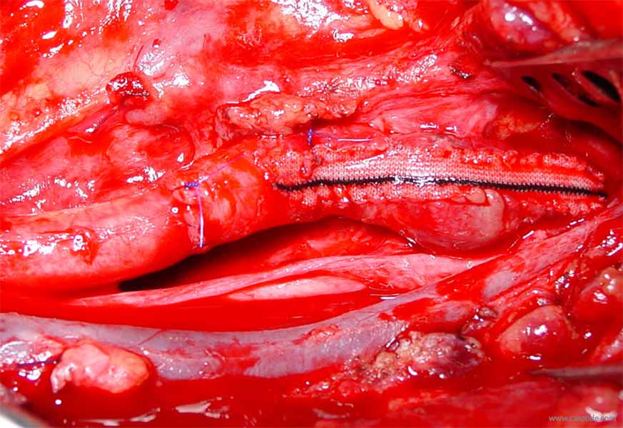 shunt carotidien avec excès de longueur, aspect final.