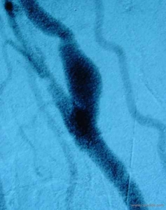 Angiographie de contrôle après chirurgie sous shunt