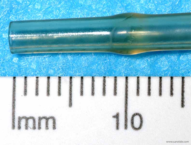 Embout distal du shunt de Javid