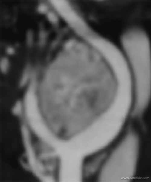 angioscanner paragangliome