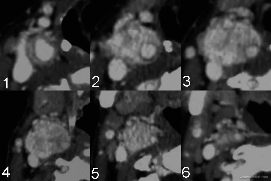 CT scan paraganglioma