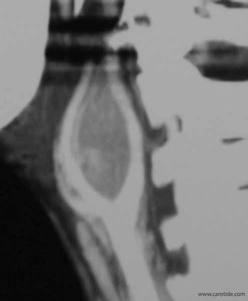 CT scan paraganglioma