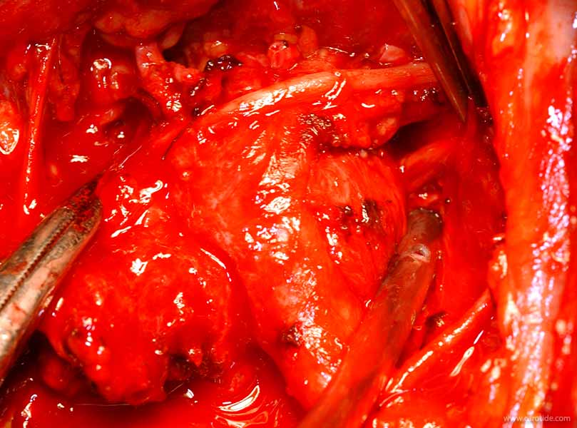 paraganglioma