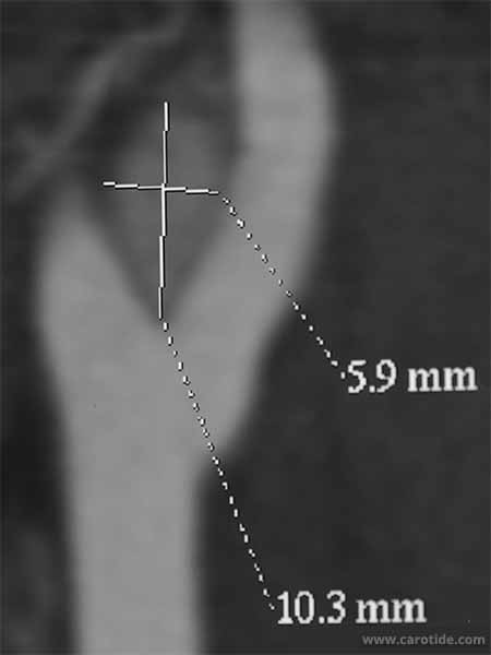Mesure d'une petite tumeur glomique angioscanner