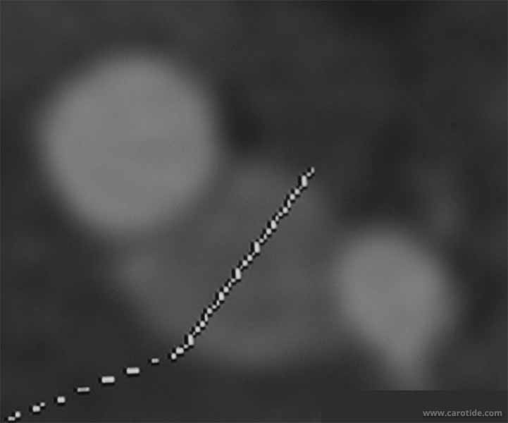 Diamètre d'une petite tumeur glomique angioscanner