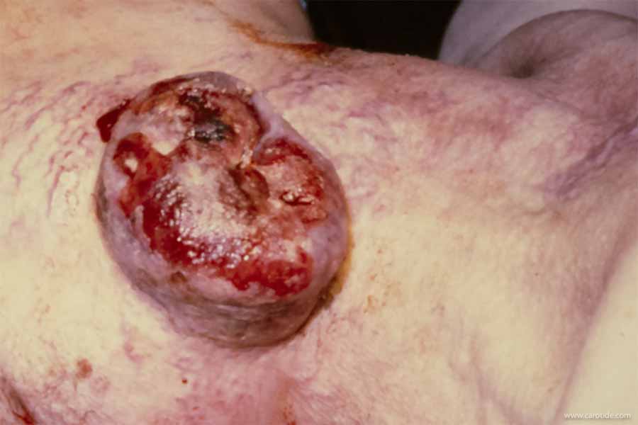 Tumeur glomique extériorisée à la peau