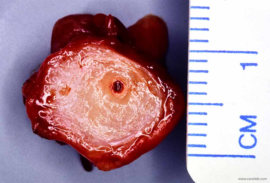 Coupe transversale du chémodectome montrant la carotide interne enserrée avec une lumière artérielle filiforme contenant du thrombus.