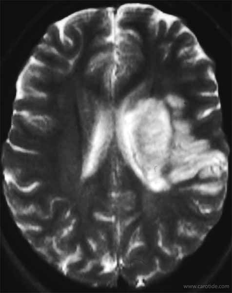 IRM cérébrale : infarctus cérébral dû à un chémodectome