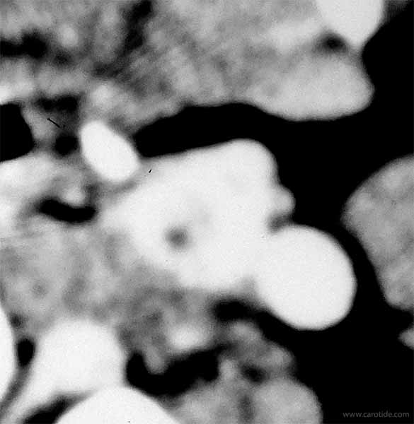 Coupe angio-scanner d'un chémodectome occlusif