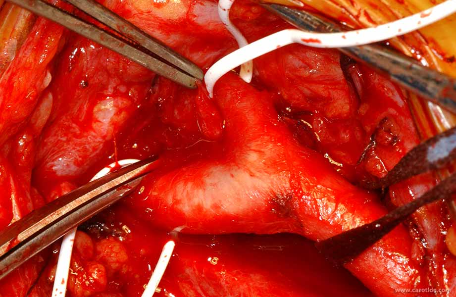 …puis de la carotide interne.