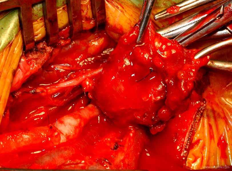 Suture de l'ostium de la carotide externe.