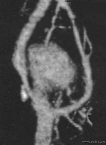 Sténose carotidienne ulcérée associée à un chémodectome.