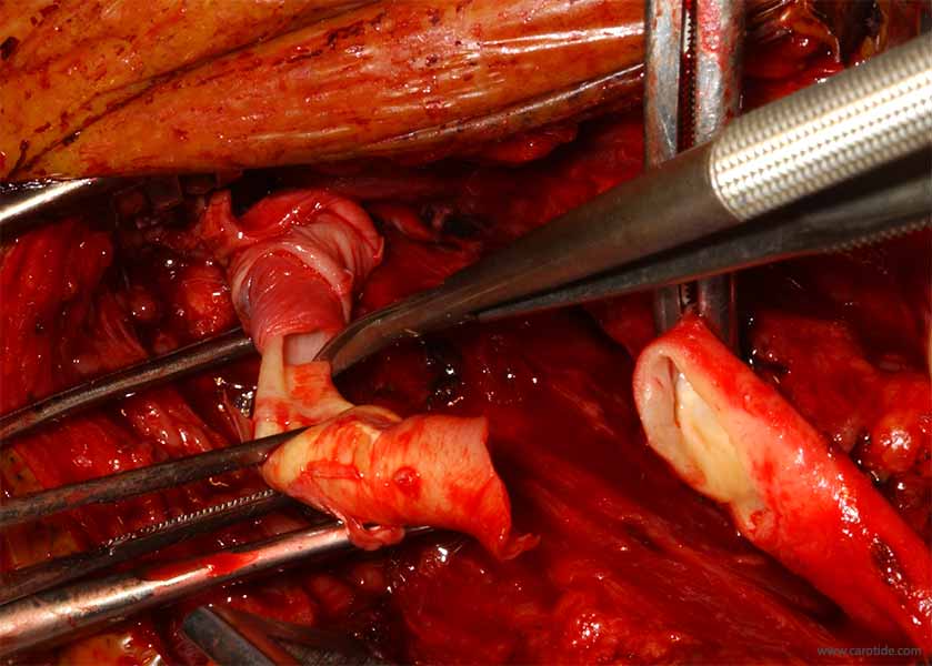 endartériectomie par éversion après ablation du chémodectome.