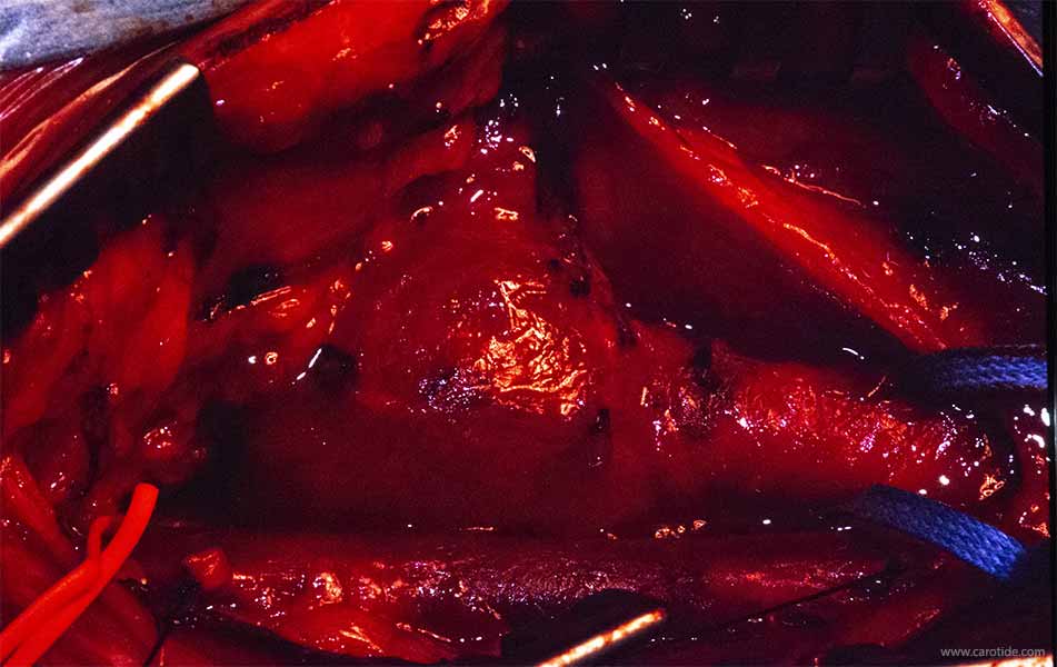 chémodectome abord chirurgical