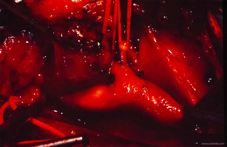 ablation de la tumeur glomique