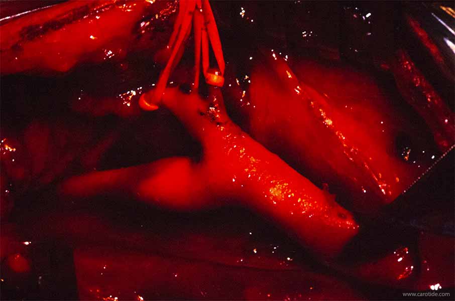 bifurcation carotidienne libérée