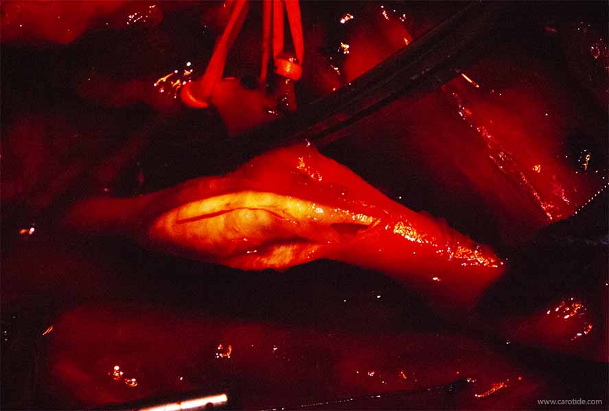 endartériectomie carotidienne
