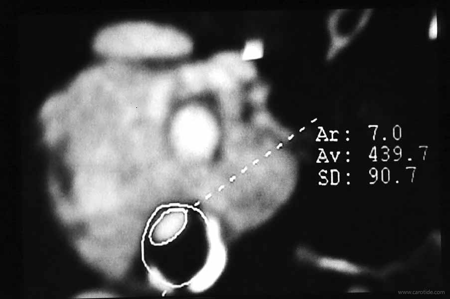 Coupe-angioscanner-chemodectome-stenose-carotidienne