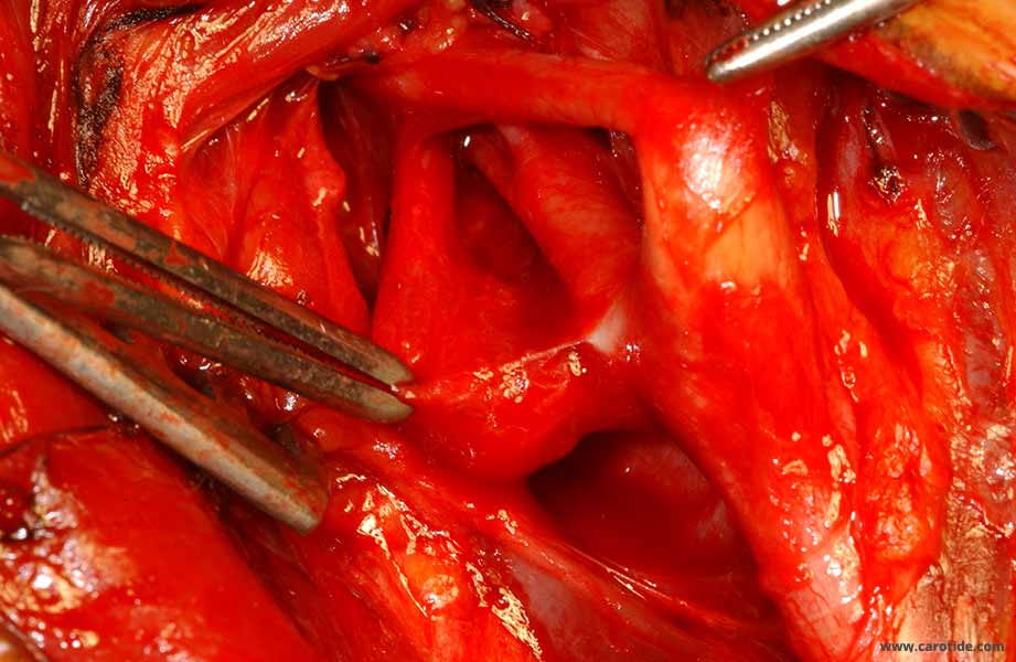 une petite artériole qui le vascularise est sectionnée,
