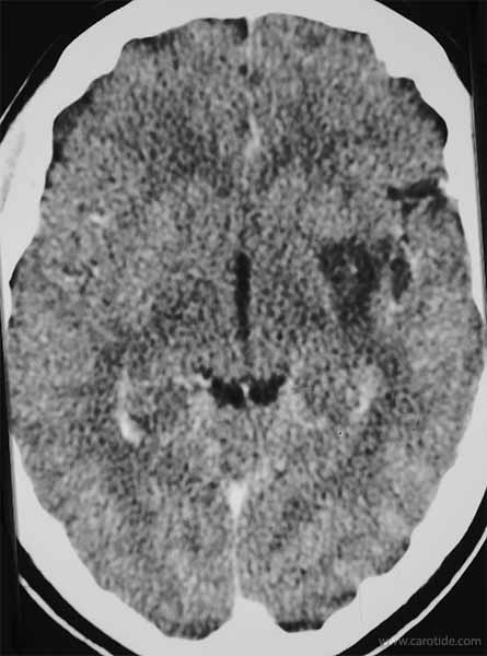 Scanner cérébral : infarctus cérébral dû à un chémodectome