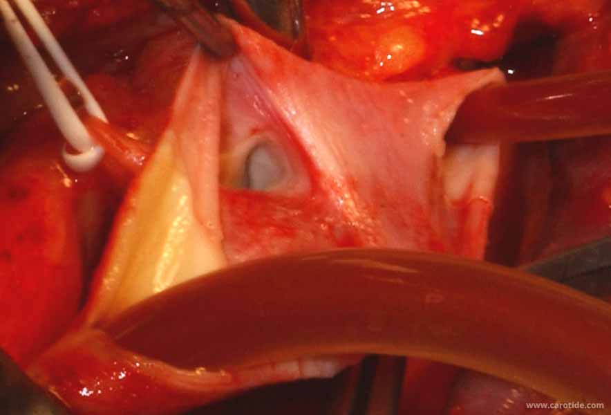 vérification de l'ostium de la carotide externe sous shunt