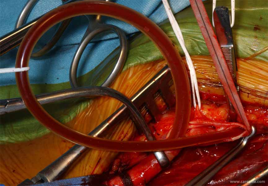 le shunt est tracté vers le bas pour faciliter la suture du patch
