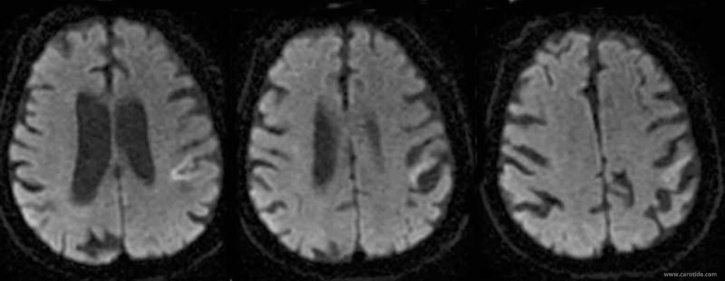 IRM diffusion montrant un infarctus cérébral