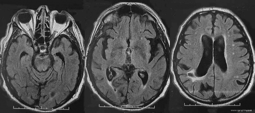 irm cérébrale montrant des séquelles d'infarctus cérébral hémisphérique droit