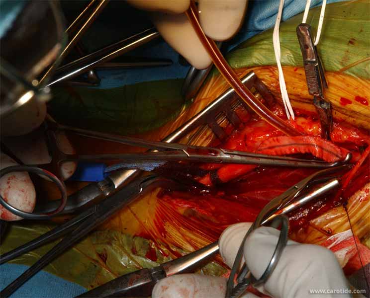 ablation du shunt