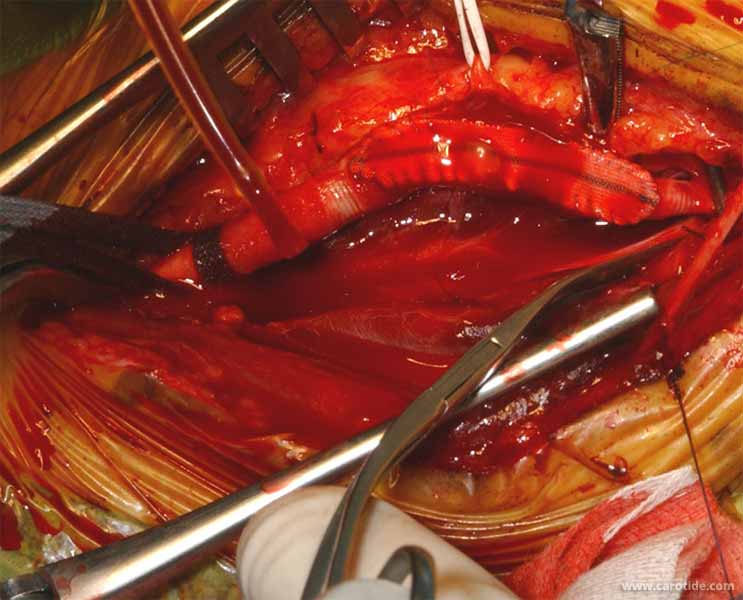 ablation du shunt de la carotideinterne