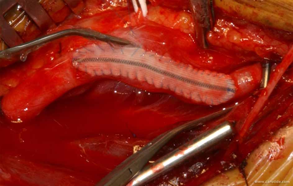 la zone d'endartériectomie est remplie de sérum hépariné.