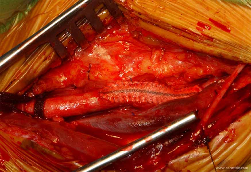 ablation du shunt carotidien : résultat final