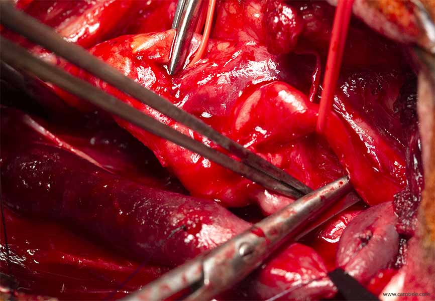 contrôle de la carotide interne en aval de l’anévrisme.
