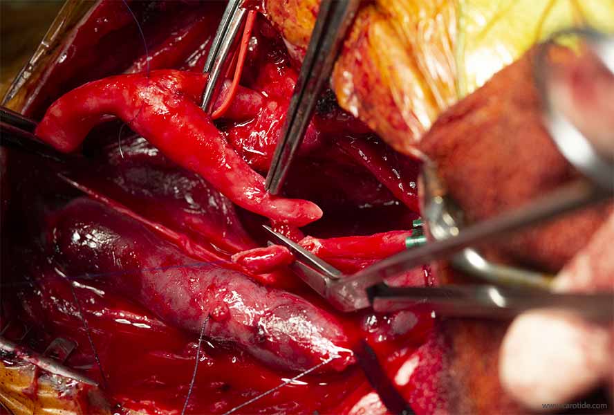 résection de l’excès de longueur de la carotide interne distale en laissant un léger excédent pour éviter une suture sous tension.