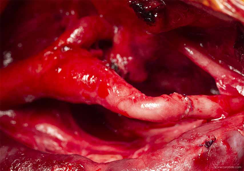 aspect final d'une anastomose termino-terminale carotidienne..