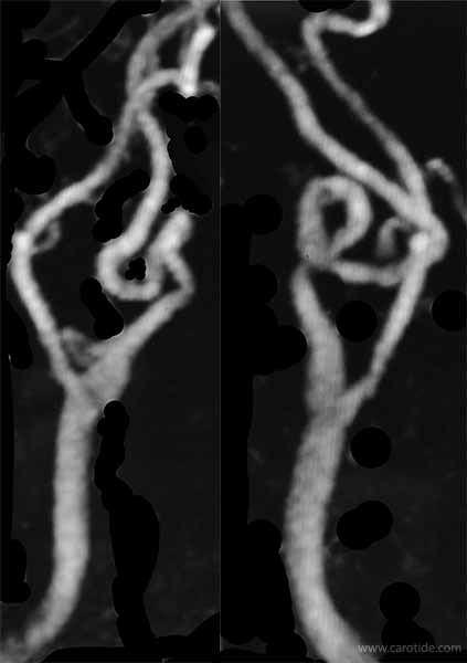 Angio-IRM d'un anévrisme carotidien
